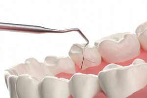 Melbourne teeth implants