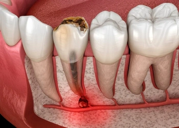 Sore Tooth After Root Canal pain