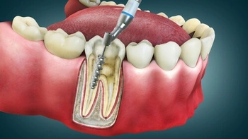 Sore Tooth After Root Canal procedure
