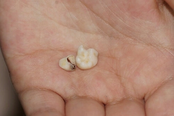 How To Remove Tooth Decay Yourself chip