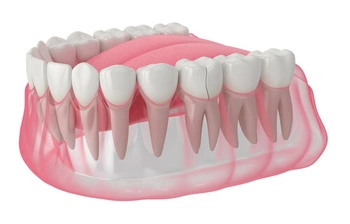 alternative to crown for cracked tooth replacement