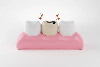 Can Tooth Decay Spread neighbor