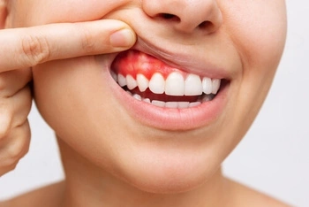 average number of root canals by age symptoms