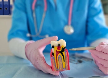 Home Remedy for Broken Tooth With Exposed Nerve decay